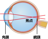 装用前（近視）