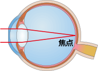 装用後（裸眼時）